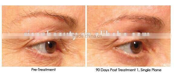 2015 CE products with 1 year warerenty 12 needles auto rolling pin auto meso pen