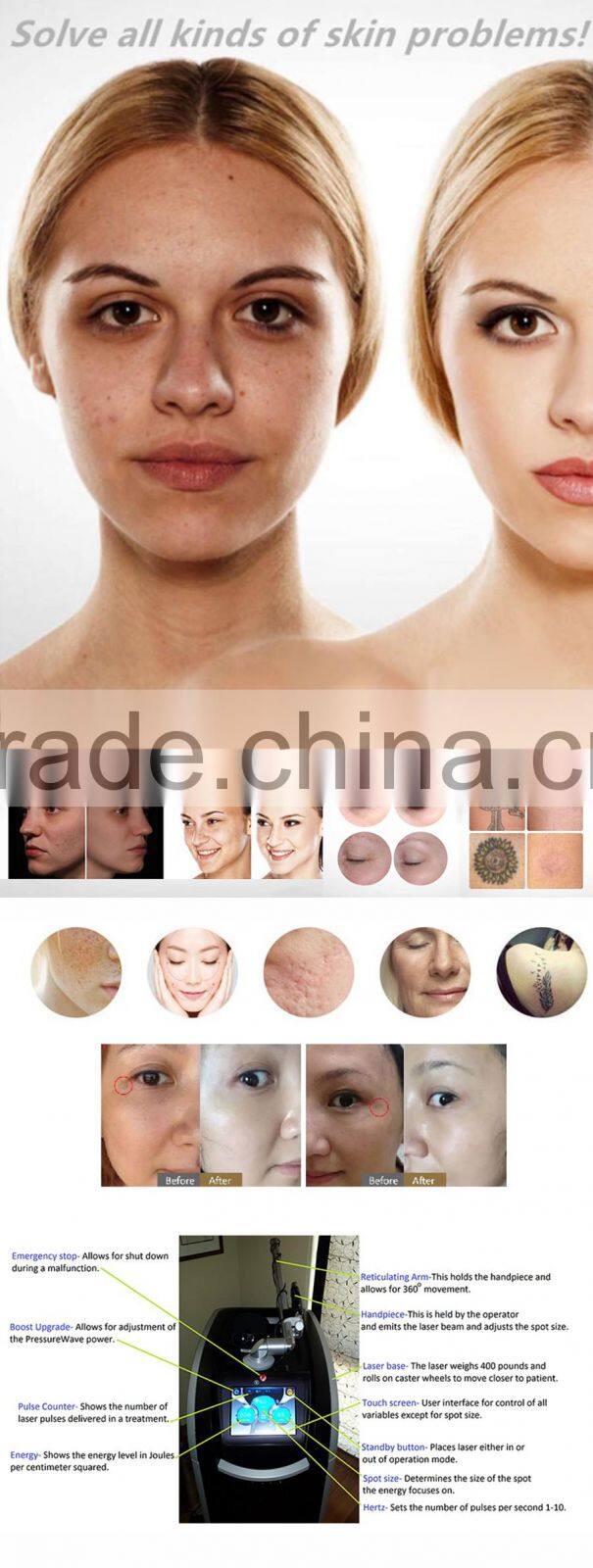 POP AL7 2016 Multifunction Laser 755nm 1064& 532nm Laser Tattoo & Acne & Scars Removal laser machine