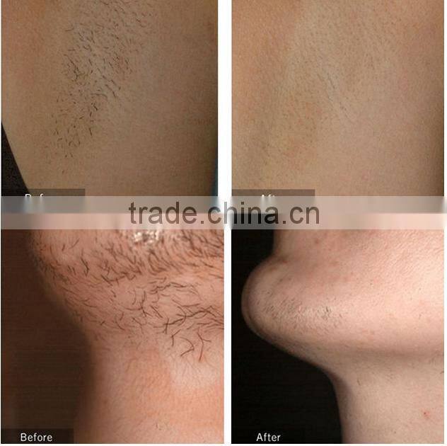 Most popular OPT +Laser nd yag + cooling RF machine