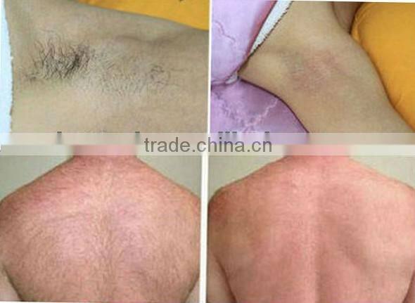 super power supply portable diode laser hair removal machine