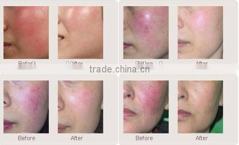 New technology optical fiber 980nm diode laser portable vasular removal medical instrument 980nm