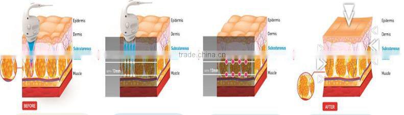 Hot new product hifu machine cryo hifu machine cryo liposunix for clinic use
