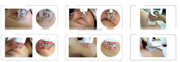 Ce approval infraed rf skin rejuvenation facial vacum