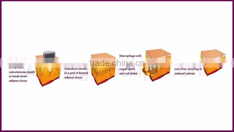 High intensity focused ultrasound body skin rejuvenation on face hifu therapy