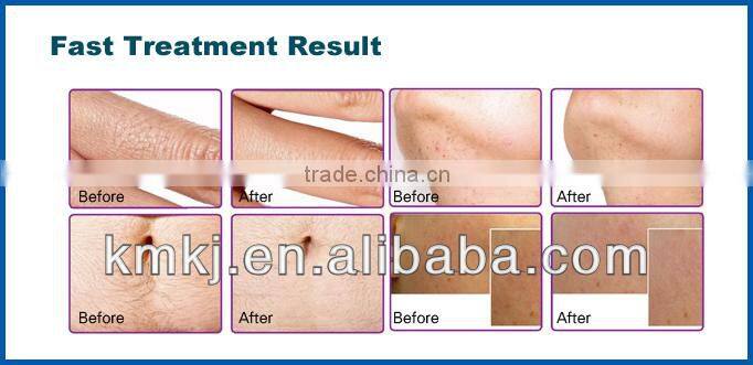 high power no pain 808nm permanent hair removal for salon