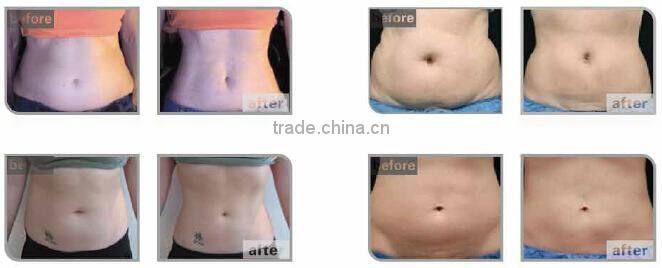 2016 newest high intensity focused ultrsound slimming HIFUSHAPE Hifu