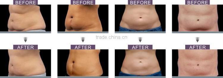 Body Sculpting Cavitation Cool Fat Freezing Cryo Slimming Lipolysis Equipement