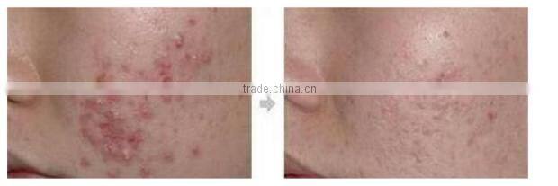 Portable Small Gas Bubble Facial Cleaning