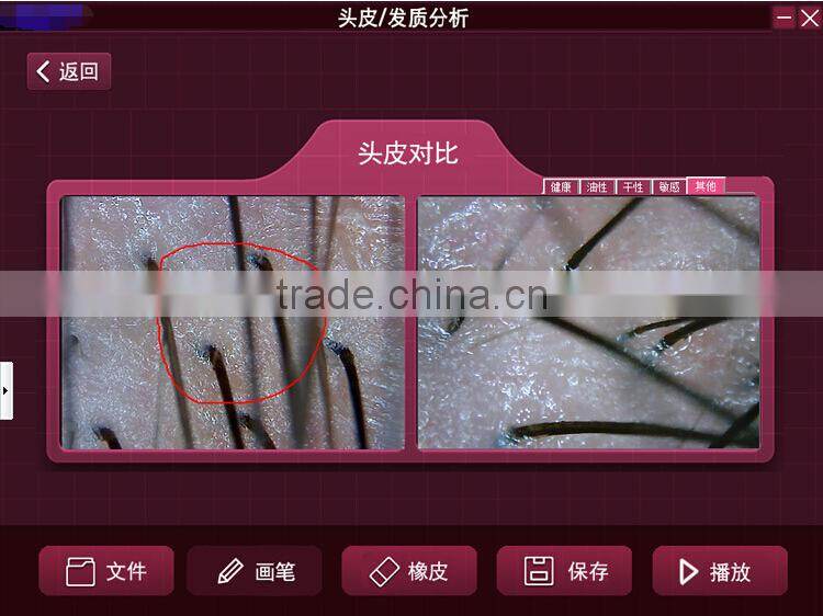 200X digital microscope scalp detector