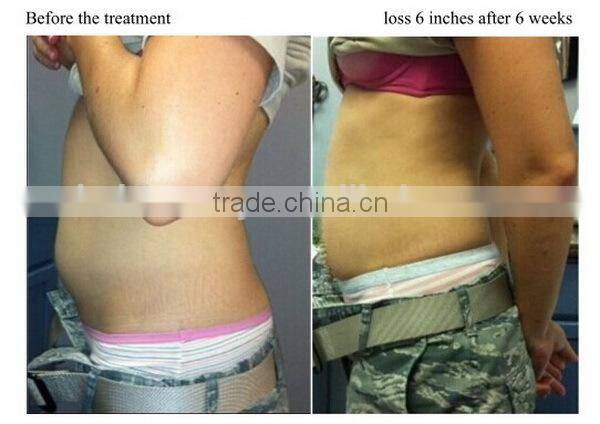 Criolipolisis Fat Freezing Slimming fat removal /Criolipolisis body slimming/ Criolipolisis Cryotherapy Machine