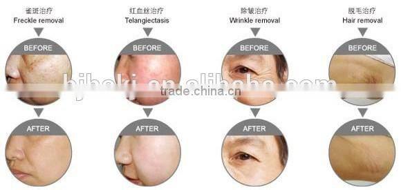 Promotion new technology Clinic use hair removal devices ipl/hair removal shr ipl