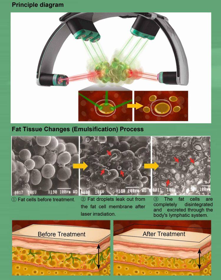 10D Maxlipo Master 532nm Laser and Inner Ball Endo Body Slimming Green Light Green Light Weight Loss for Fat Removal