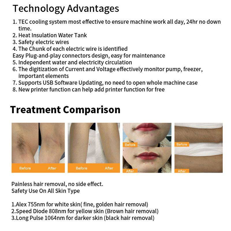 Best 3000w 3 Wavelength 808nm Diode Laser Hair Removal Machine Germany Bar 808nm Diode Hair Removal Laser Beauty Machine