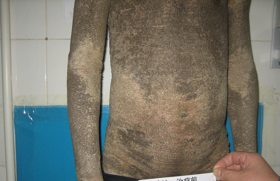 How  to treat ichthyosis and dry skin?
