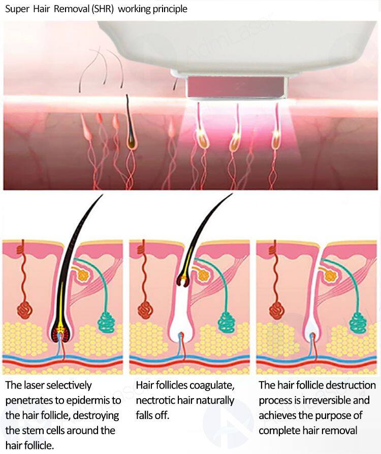 Portable DPL Optical Skin Beautification Skin Rejuvenation BBL Pigmentation 480nm Dpl Freckles Age Spots Removal