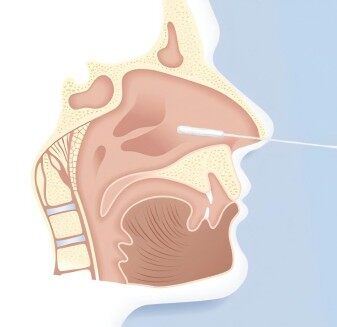 Comprehensive Guide to Upper Respiratory Tract Specimen Collection