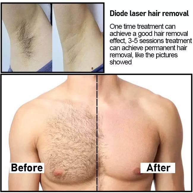 Updated Factory Wholesale Price 4 Wavelength 808m Diode Hair Laser Removal Machine Permanent Hair Removal by Laser