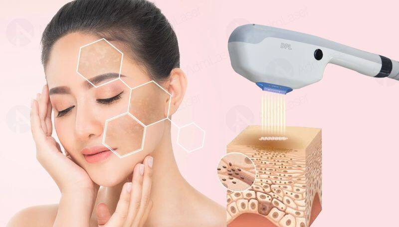 Portable DPL Optical Skin Beautification Skin Rejuvenation BBL Pigmentation 480nm Dpl Freckles Age Spots Removal