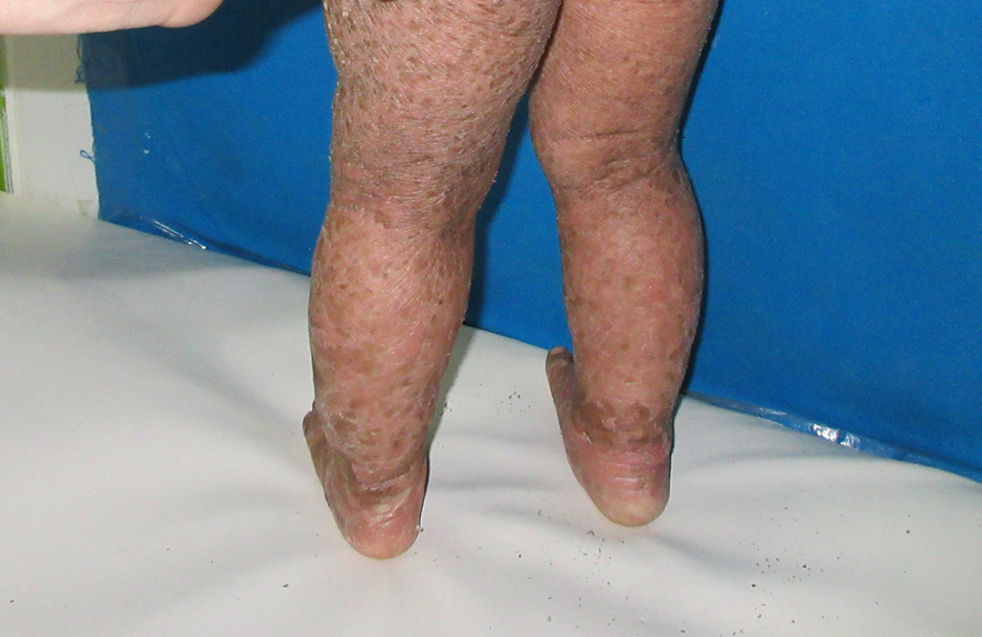 How do you get rid of fish scales on legs?