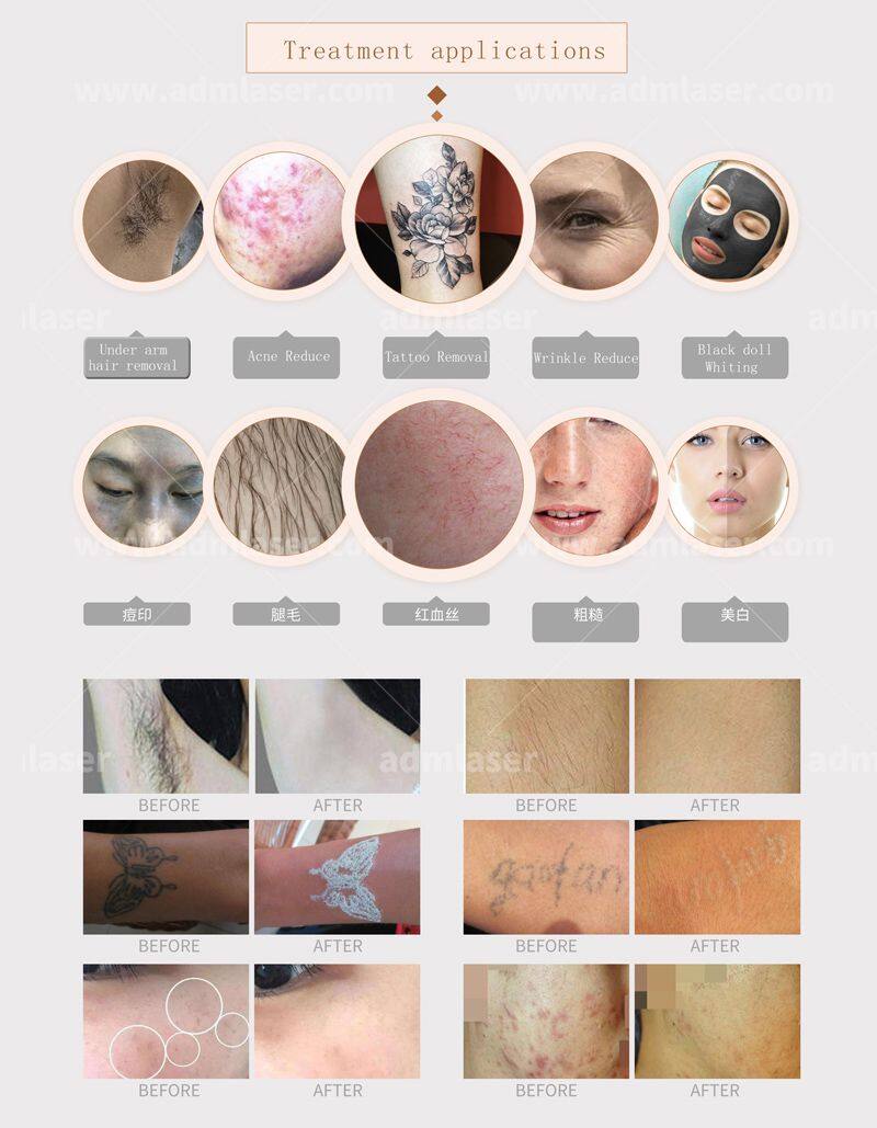 Portable 2 in 1 Q Switch Nd Yag Laser Tattoo Remover With Ipl Laser Hair Removal