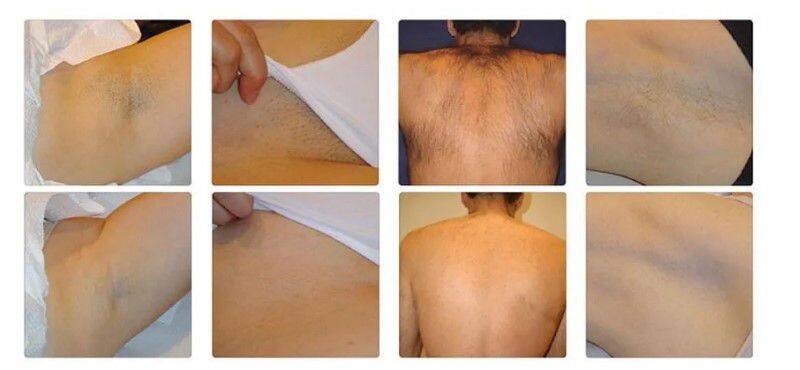 High Quality 755nm Alexandrite Laser 1064nm Long Pulse Laser Hair Removal Alexandrite Laser Device