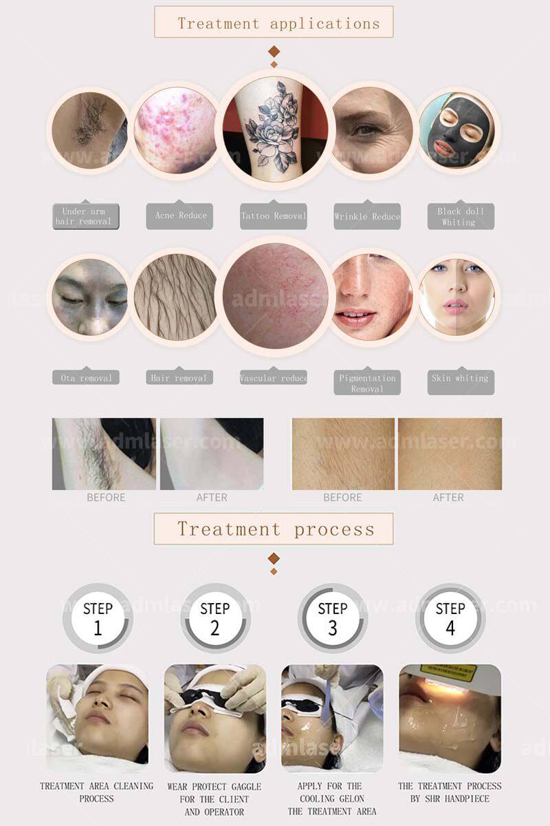 CE Approved IPL Laser Elight Ipl for Hair Removal and Whiten Skin E-light OPT Hair Removal Beauty Machine