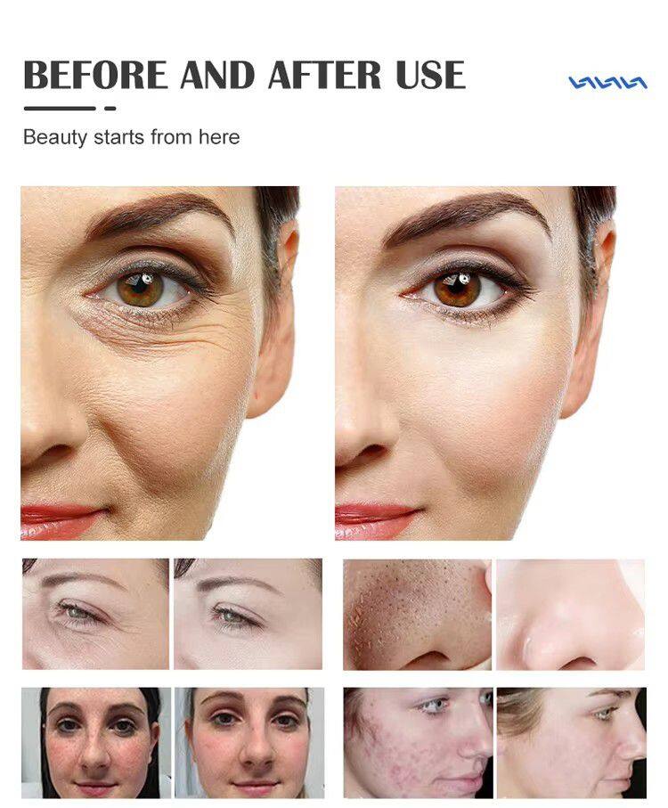 ADM Popular Product Microdermabrassion and Hydra Oxygen Facial Skin Rejuvenation Deep Cleaning Hydra Oxygen Facial Machine 2024