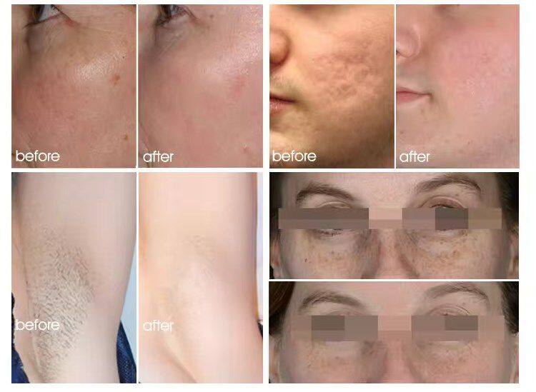 Portable DPL Optical Skin Beautification Skin Rejuvenation BBL Pigmentation 480nm Dpl Freckles Age Spots Removal