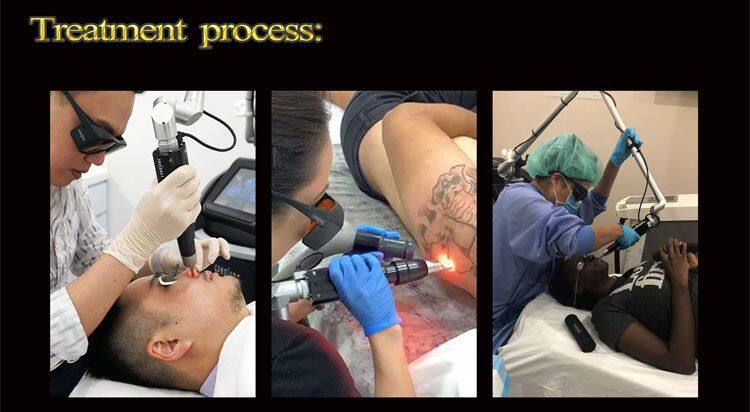 Non-Invasive Portable NDyag Pico Laser Beauty Machine Q-Switched Nd Yag Laser Pico Black Dot Skin Whitening Beauty Equipment