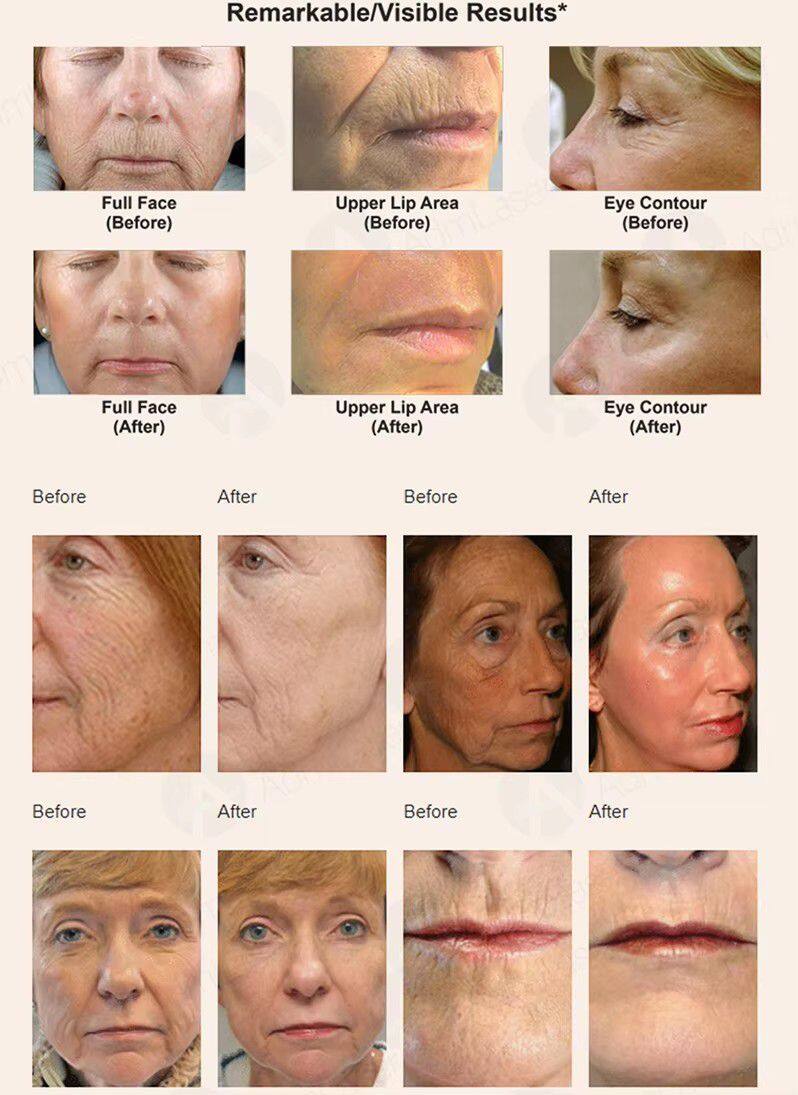 ADM Top Quality CE Approved Vaginal Tightening Fractional Co2 Laser Acne Scar Removal Skin Resurfacing CO2 Laser Machine