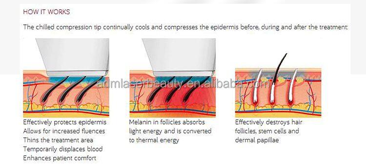 CE Approved IPL Laser Elight Ipl for Hair Removal and Whiten Skin E-light OPT Hair Removal Beauty Machine