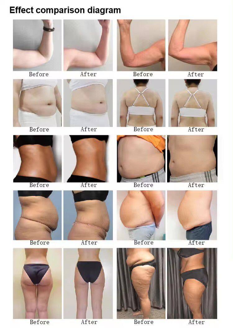 10D Maxlipo Master 532nm Laser and Inner Ball Endo Body Slimming Green Light Green Light Weight Loss for Fat Removal