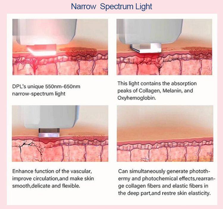 Portable DPL Optical Skin Beautification Skin Rejuvenation BBL Pigmentation 480nm Dpl Freckles Age Spots Removal