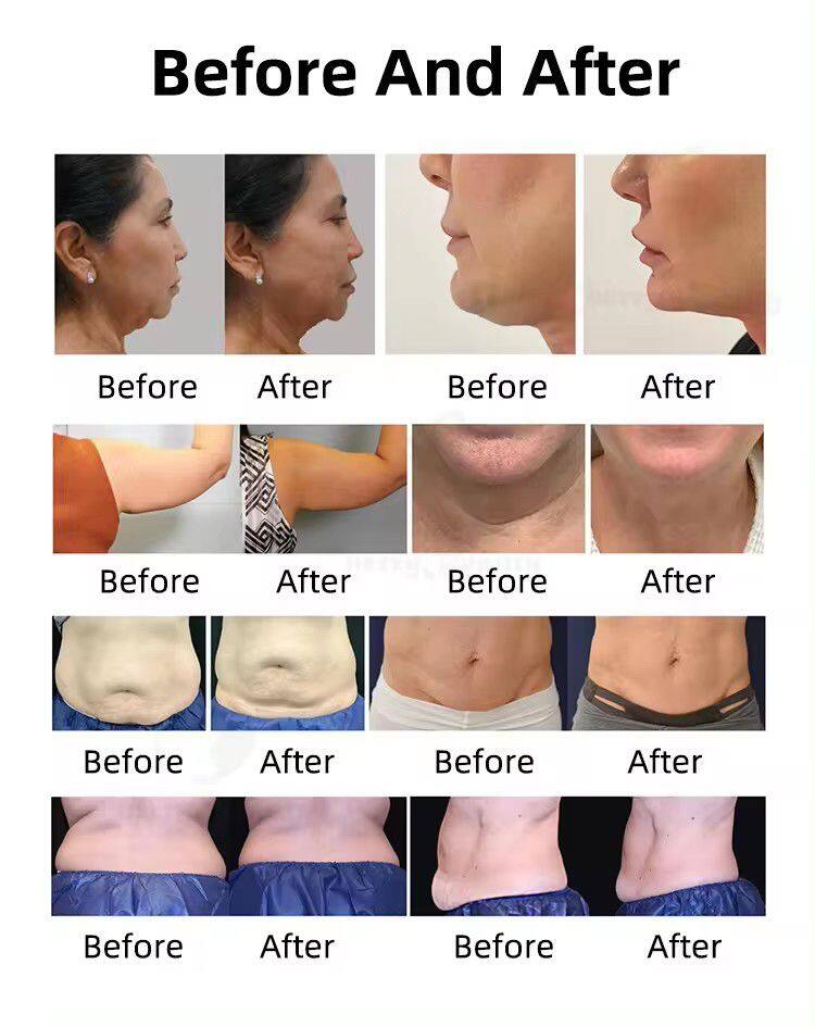 Professional Trusculpt ID Ice Body Sculpture Belly Cryo Slimming Therapy Fat Reducing Machine