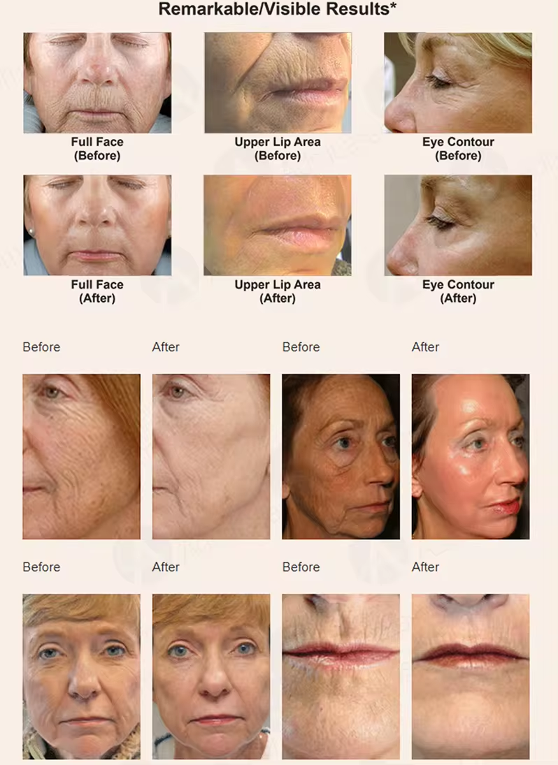 CO2 Laser Fractional Tighten Vagina Remove Scars and Stretch Mark Medical Fractional Co2 Laser Vaginal 2024