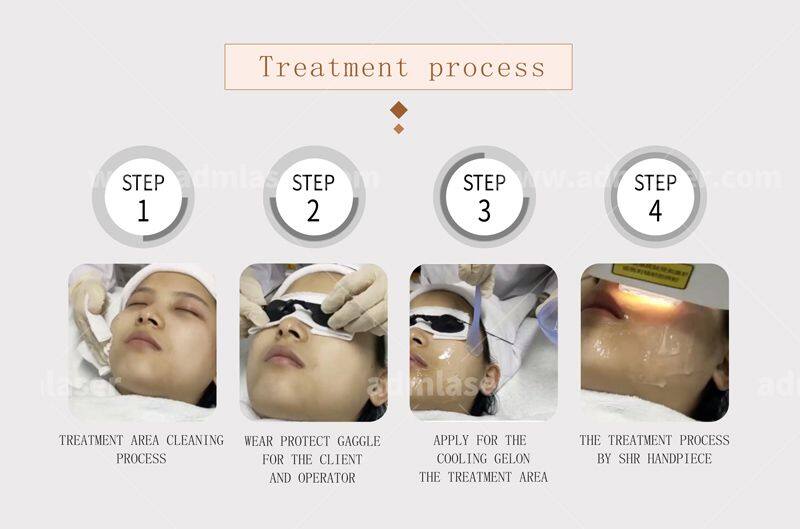 Portable 2 in 1 Q Switch Nd Yag Laser Tattoo Remover With Ipl Laser Hair Removal