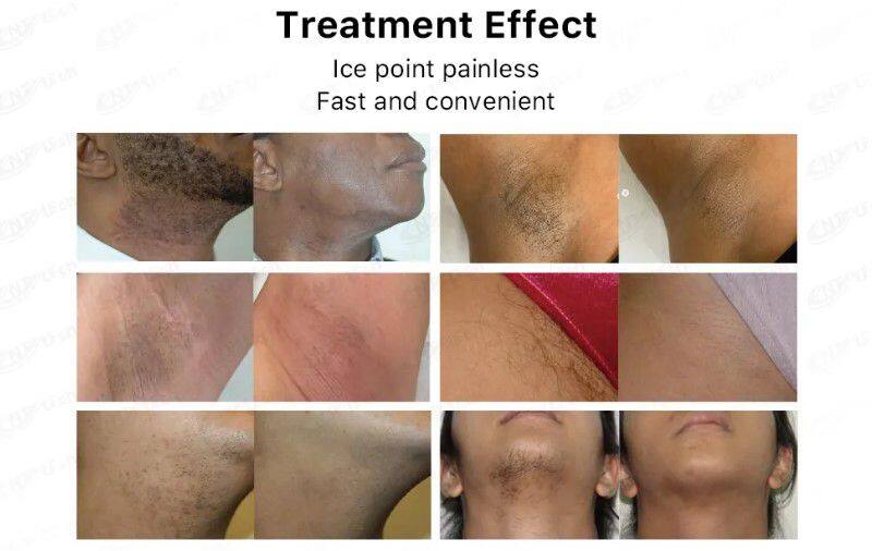 2024 ADM High Power Painless Portable 808 Diode Laser Hair Removal 755nm 1064nm 808nm Diode Laser Beauty Machine