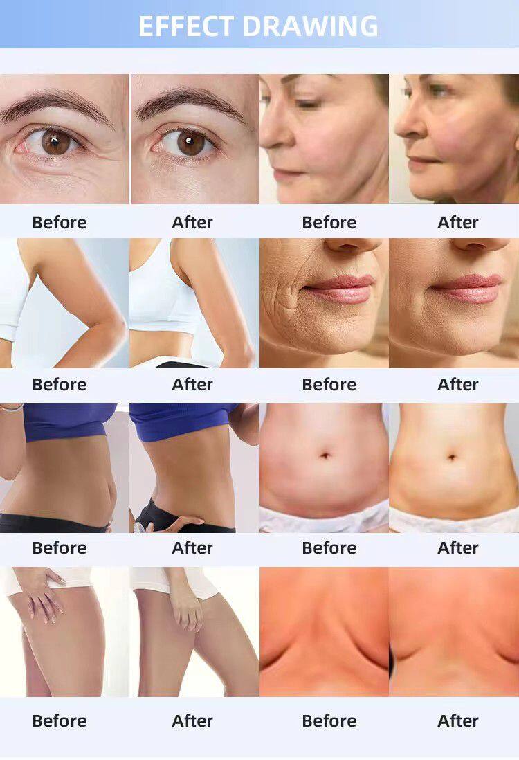 Micro Needle RF Face Lifting and Fat Reduce for Face Body Slimming ICE Beauty Equipment