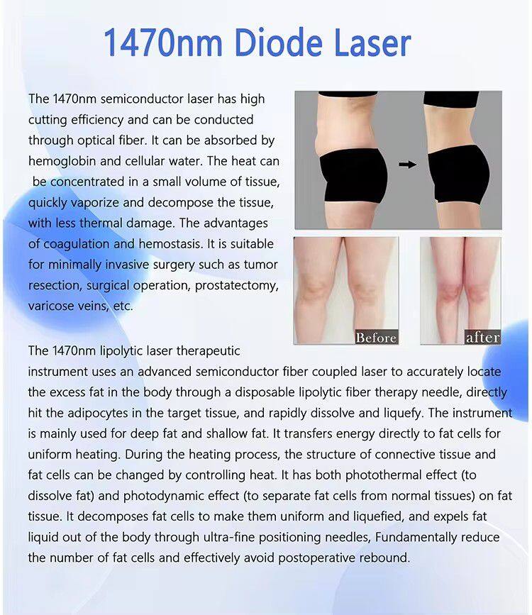 Professional Facial Slimming Face Lift Anti-Aging 1470 Diode Liposuction Machine 1470nm Laser Endolifting Lipolysis