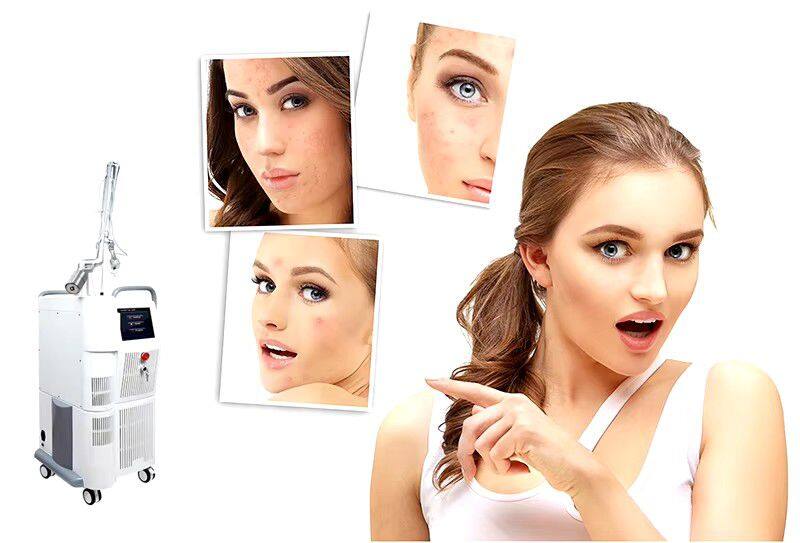 ADM Top Quality CE Approved Vaginal Tightening Fractional Co2 Laser Acne Scar Removal Skin Resurfacing CO2 Laser Machine