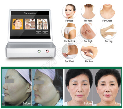 What Is 3D HIFU Face Skin Care