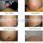 Good Effect Cryolipolysis Weight Loss Machine/laser Cool Sculpting Lose Weight(809nm Laser Led) Skin Tightening