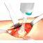 High Quality Medical Orthopedic Trauma Surgery Disposable Pulse Lavage