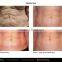 PEMF Multipolar rf wrinkle removal -PEMF Shape II