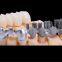 Digital-Crowns-Bridges Chinese Dental Lab Denture