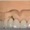China Porcelain Fused to Metal Bridge Dental Supply Dental Crown Equipment Denture Orthodontic Dental Implant Products