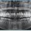 Dental Digital Panoramic and Cephalometric X-ray Machine