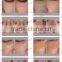 Vaginal Rejuvenation Fractional Co2 Laser Medical Ultra 15W(20W) Pulse Machine/co2 Laser Surgery Machine Treat Telangiectasis