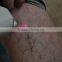 Arm / Chest Hair Removal Laser Diode 808nm Unwanted Hair Hair Removal Device Clinic Home