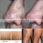Veins removal dioden laser 980 / diode laser 980nm / laser diode for removal vein